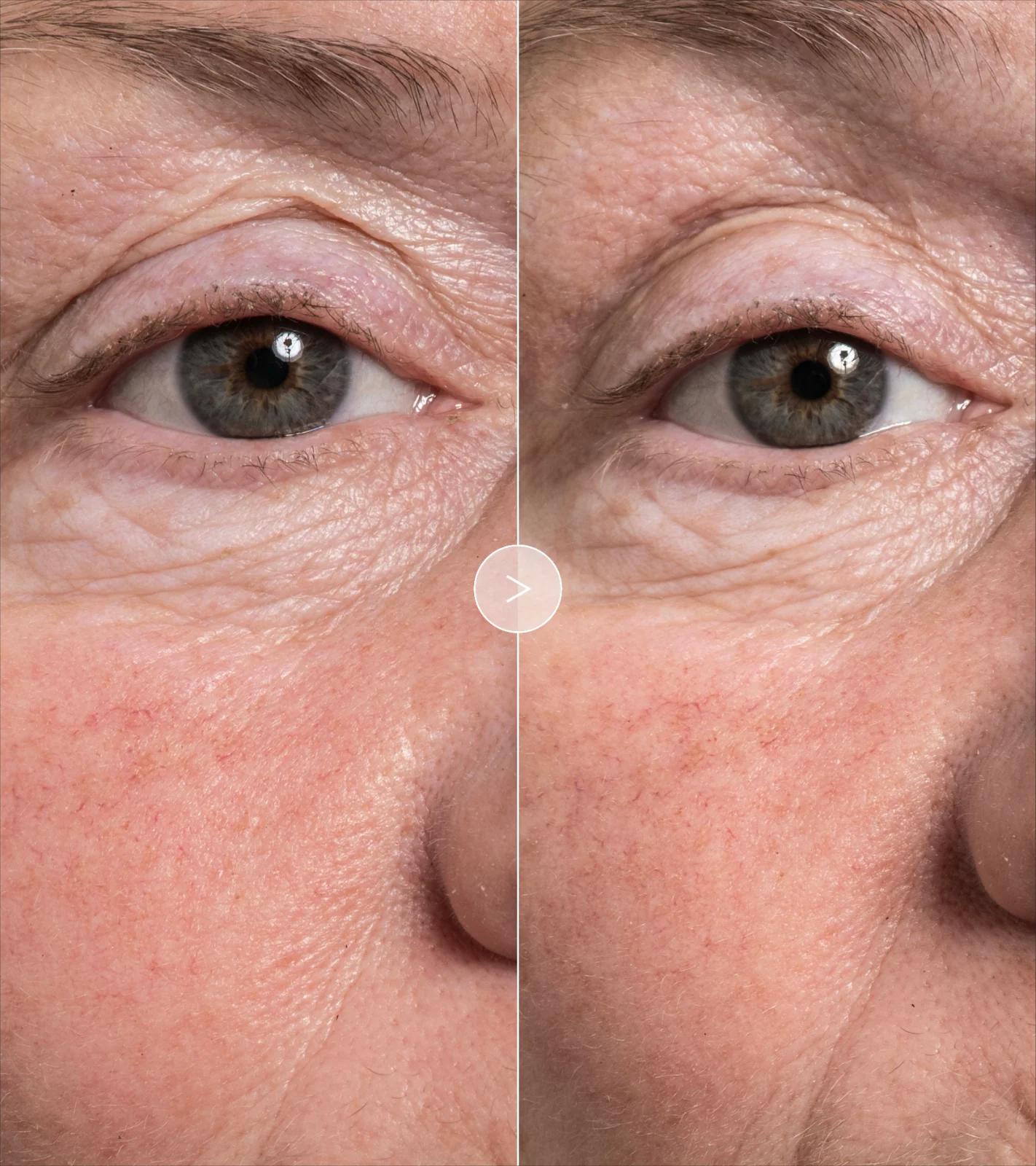 The Exceptional Eye Lift